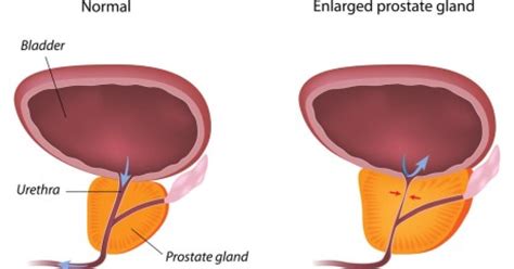 Transurethral Resection Of The Prostate Turp Procedure