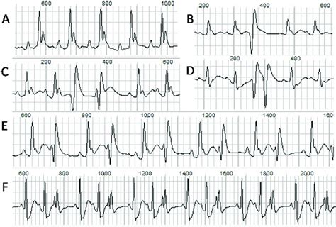 The Normal Ecg And Different Types Of Ventricular Arrhythmias A