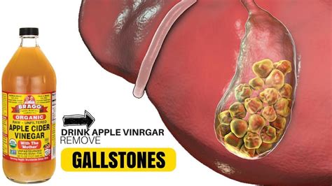 How To Get Rid Of Gallstones Naturally With Apple Cider Vinegar In 24