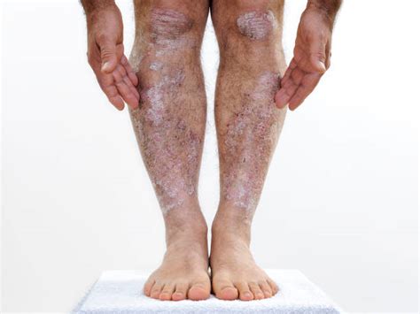 Psoriasis On Legs Stock Photos Pictures And Royalty Free Images Istock