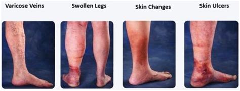 Chronic Venous Insufficiency Overview And Advanced Treatment Options