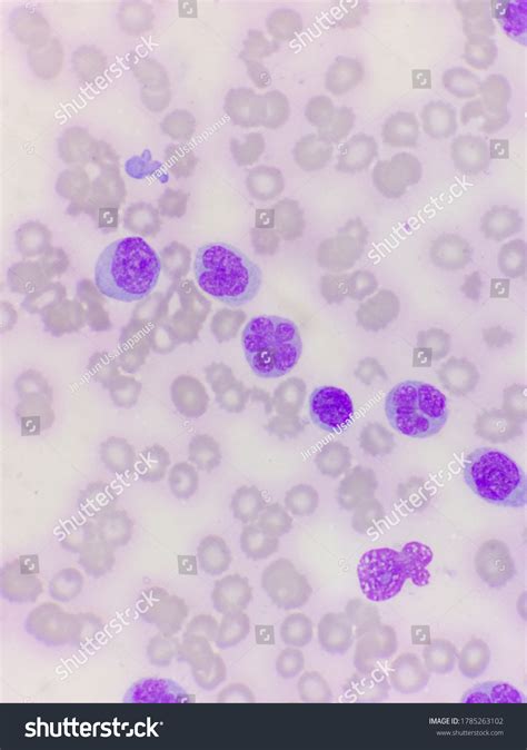 Monoblast That Apoptosis Peripheral Blood Smear Stock Photo 1785263102