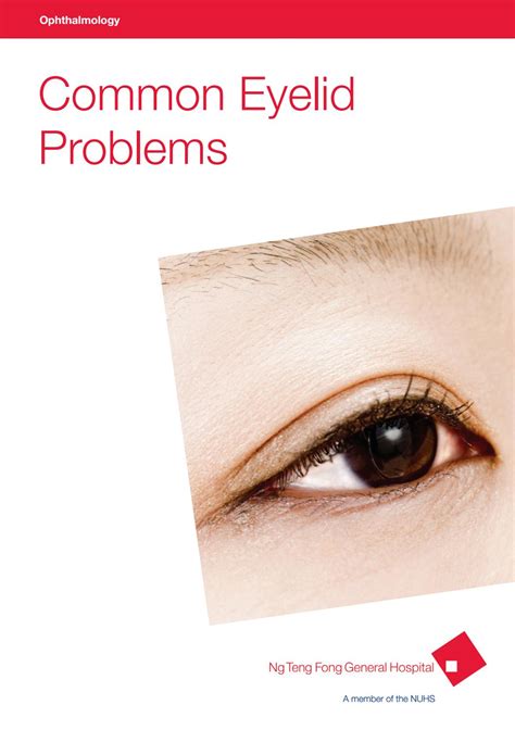 Ophthalmology Common Eyelid Problems By Juronghealth Campus Issuu