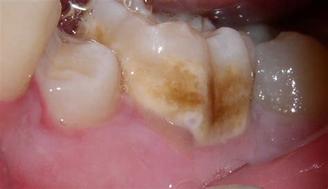 Faq What Are Hypocalcified Teeth — Discovery Pediatric Dentistry