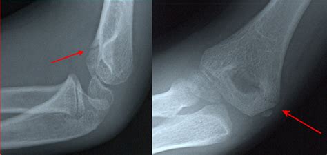 Distal Humerus Fractures Lateral Condylar Fracture