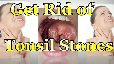 Easy and Best Ways To Naturally Get Rid of Tonsil Stones ! Powerful