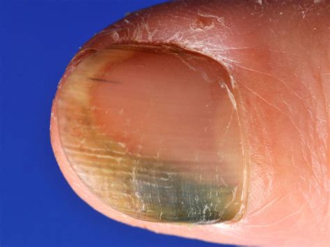 Pseudomonas aeruginosa is an opportunistic pathogen. Pseudomonas aeruginosa onychopathie, Pseudomonas nagels