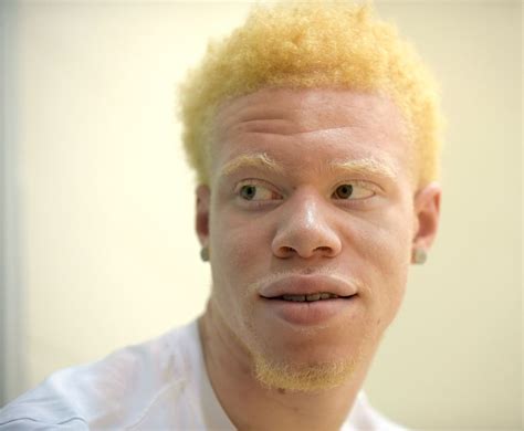 Albino Black Human