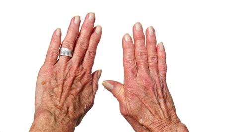 Other symptoms of psa include having puffy fingers and toes that resemble sausages (a condition called. Pictures of Arthritis in Fingers and Knuckles