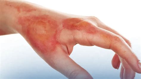 Types Of Burns And Effective Treatment Methods