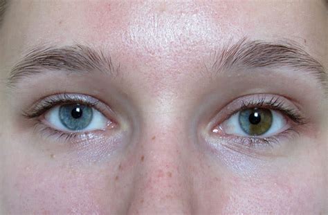 Heterochromia Different Colored Eyes Causes And Types