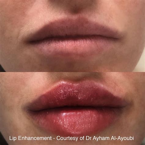 Fat Transfer To Lips Before And After
