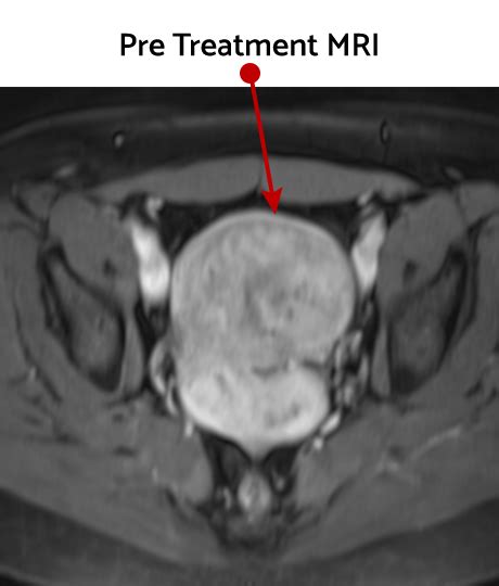 Uterine Fibroid Embolization Vip Northwest Radiology Indianapolis