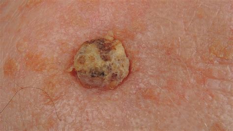 Carcinoma Multiple Skin Cancers Mainly Squamous Cell