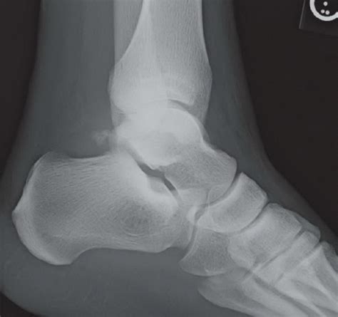 Lateral Process Of Talus Fracture Radiology Key