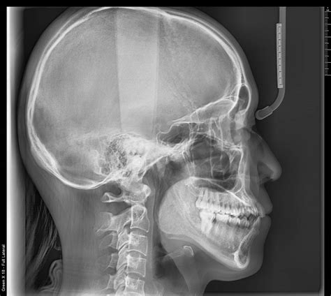 32m Mse Class Iii Malocclusion With A Recessed Jaw Case