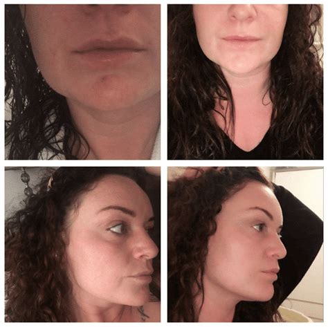 Skin Transformation Before And After One Skinbase Facial