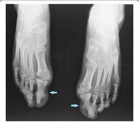 Dorso Plantar Radiograph Of Bilateral Feet Showing Hallux Valgus