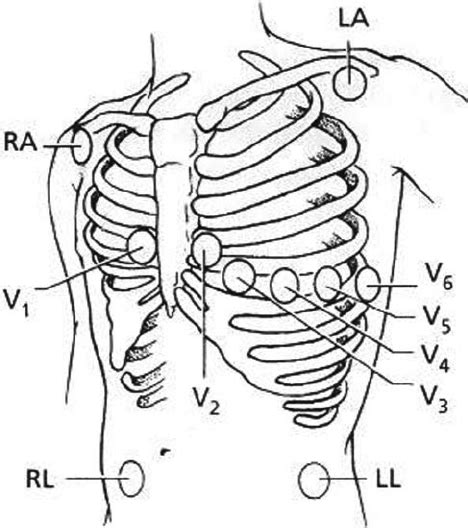 Figure 5 Mason Likar 12 Lead Ecg System Anatomic Locations For