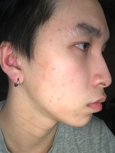 Routine Help Red Patches On Face Around Cheeks And Temple