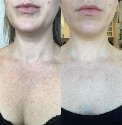 Ipl Before And After Pictures Case 62 Sacramento Ca Destination