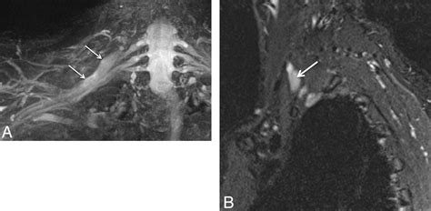 High Resolution 3t Mr Neurography Of The Brachial Plexus And Its