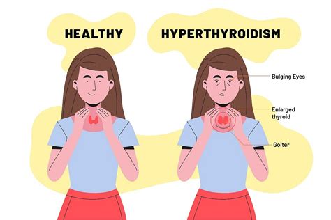 A Simplified Guide To Hyperthyroidism Signs Symptoms And Dietary Tips