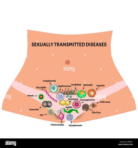 Infecciones Virales Y Bacterianas Enfermedades De Transmisión Sexual Infografías Ilustración