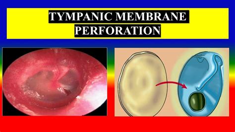 TYMPANIC MEMBRANE PERFORATION Define Etiology Risk Clinical