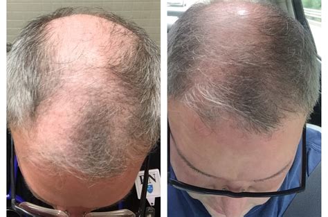 Non Surgical Hair Restoration A New Results Based Innovation Canton