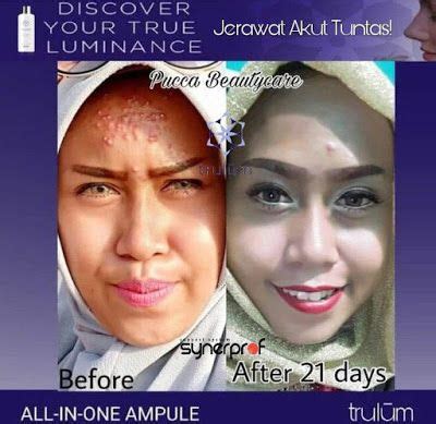 The most reliable place for accurate and unbiased hotel reviews. Serum Trulum Review / Jual Trulum Skincare Synergy 120ml ...