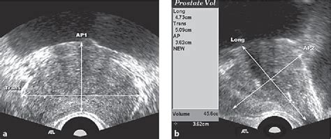 Figure From Comparison Of Prostate Volume Measured By Transrectal Ultrasonography And MRI With