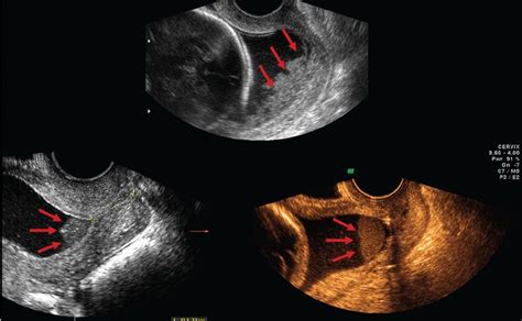 imaging of the uterine cervix radiology key