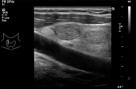 Benign Thyroid Nodule Ultrasound