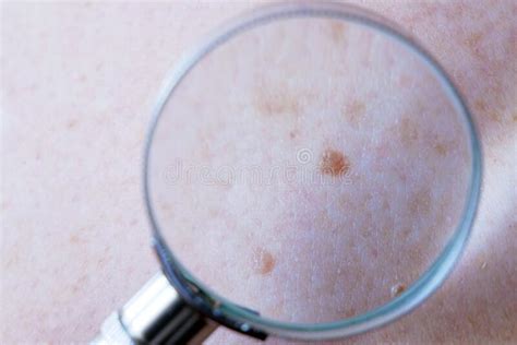 Doctor Dermatologist Examines Birthmark Of Patient Checking Benign