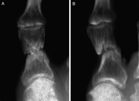 Nonunion In Proximal Phalanx Of Great Toe Treated By Grafting With