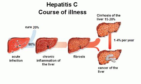 Hepatitis c is one of the most common types of viral hepatitis. Hepatitis C - DECODE