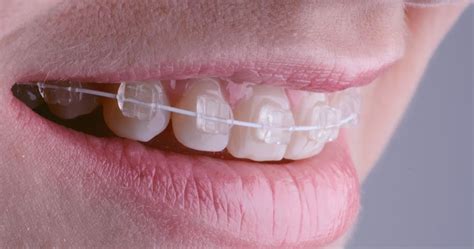Invisible Orthodontics Esthetic Brackets