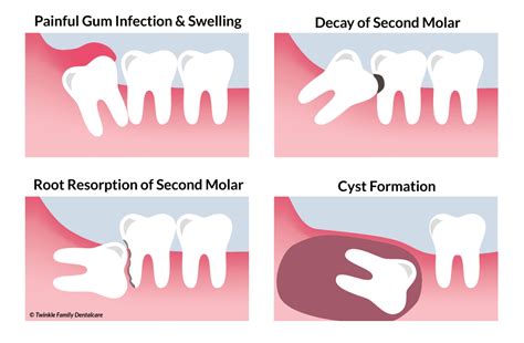 Is It Wise To Remove My Wisdom Teeth Medisave Claimable For Surgery