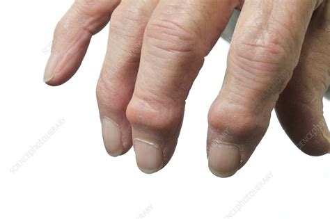 Osteoarthritis Of The Hand Stock Image C0103320 Science Photo