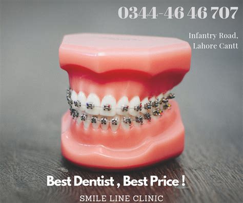 When you do a search for information on phase i orthodontic treatment you will readily find a lot of critics. Best Orthodontist Lahore, Best Dentist, Smile Line ...