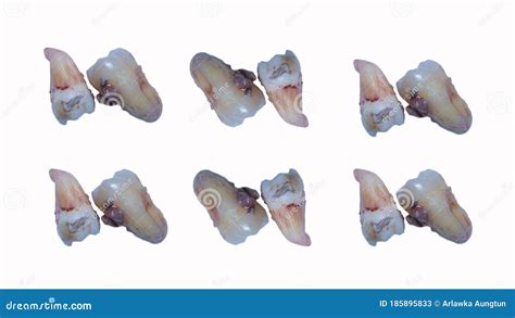 Dentistry Wisdom Teeth Plucked Out Placed On A White Stock Image