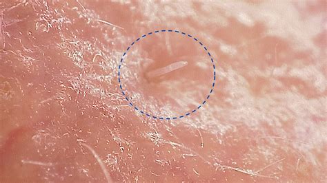 Human Scabies Mite Hot Sex Picture