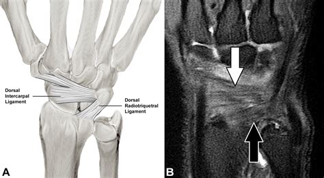 Preoperative And Postoperative Imaging Of Scapholunate Ligament Primary Repair And Modified