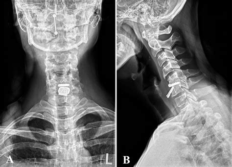 Complications And Complication Avoidance With Cervical Total Disc