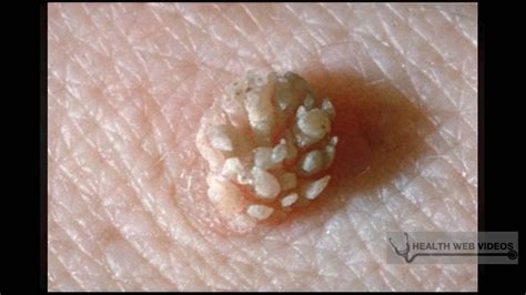 How To Get Rid Of Genital Warts Creams Therapy And Other Treatment