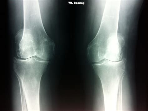 Bilateral Knee Osteoarthritis X Ray Ap The Podiatry Practice