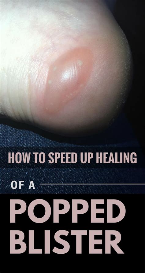 how to speed up healing of a popped blister blister treatment blister remedies health and