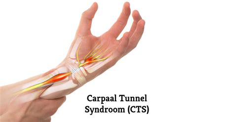Carpaal Tunnel Syndroom Symptomen Operatie Behandeling