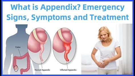 What Is Appendix Emergency Signs Symptoms And Treatment